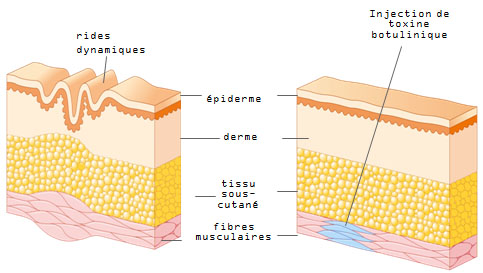 Schéma de l'injection du Botox dans le muscle